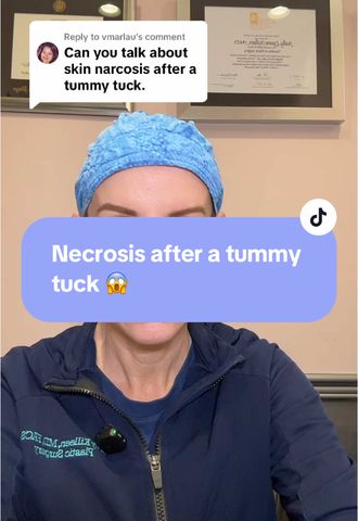 Skin Necrosis After a Tummy Tuck: Why It Happens and How We Treat It