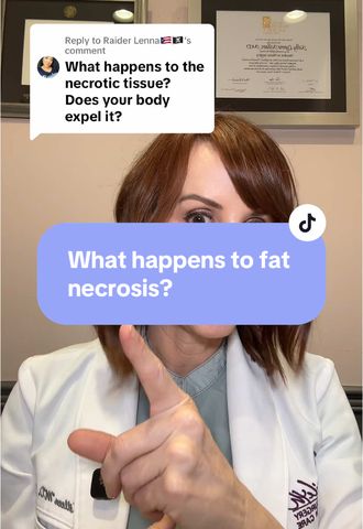 What Happens to the Fat That Doesn't Survive After a BBL or Fat Grafting?