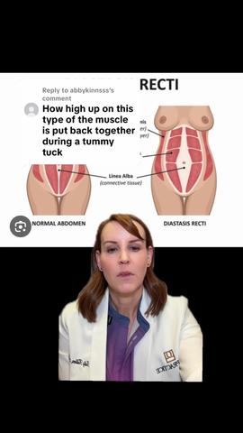How High Up Do We Go When Repairing Diastasis in a Tummy Tuck?