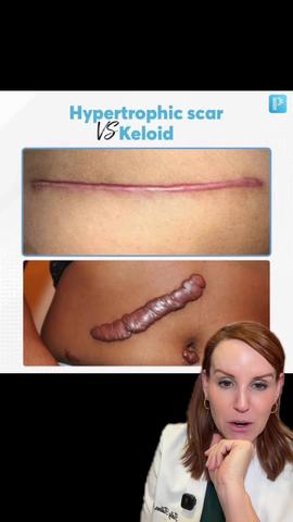 Hypertrophic vs. Keloid Scars — and How They Look on Darker Skin